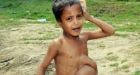 Surgeons cut off Indian boy's 'parasitic twin'