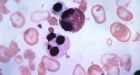 Transplant may have cured man of HIV: report